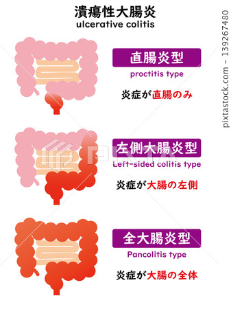 潰瘍性結腸炎 139267480