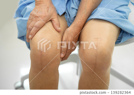 Asian elderly woman patient show her scars surgical total knee joint replacement Suture wound surgery arthroplasty on bed in hospital. 139282364