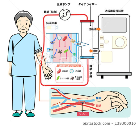 An illustration that clearly shows how hemodialysis works. An illustration that clearly shows how hemodialysis works. 139300010