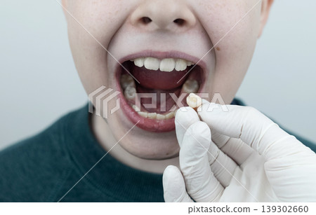 10 year old boy at pediatric dentist showing milk tooth extraction. Concept of caries treatment, physiological change of teeth and permanent teeth eruption in school age children. 10 year old boy at pediatric dentist showing milk tooth extraction. Concept of caries treatment, physiological change of teeth and permanent teeth eruption in school age children. 139302660