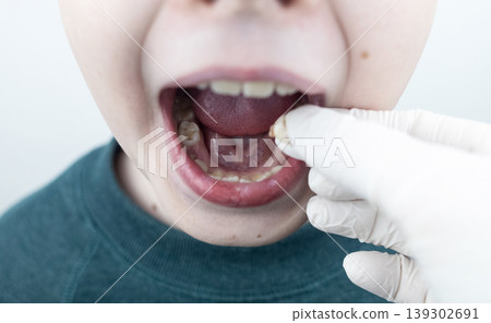 10 year old boy at pediatric dentist showing milk tooth extraction. Concept of caries treatment, physiological change of teeth and permanent teeth eruption in school age children. 10 year old boy at pediatric dentist showing milk tooth extraction. Concept of caries treatment, physiological change of teeth and permanent teeth eruption in school age children. 139302691