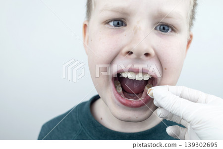 10 year old boy at pediatric dentist showing milk tooth extraction. Concept of caries treatment, physiological change of teeth and permanent teeth eruption in school age children. 10 year old boy at pediatric dentist showing milk tooth extraction. Concept of caries treatment, physiological change of teeth and permanent teeth eruption in school age children. 139302695