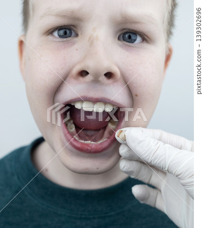10 year old boy at pediatric dentist showing milk tooth extraction. Concept of caries treatment, physiological change of teeth and permanent teeth eruption in school age children. 10 year old boy at pediatric dentist showing milk tooth extraction. Concept of caries treatment, physiological change of teeth and permanent teeth eruption in school age children. 139302696
