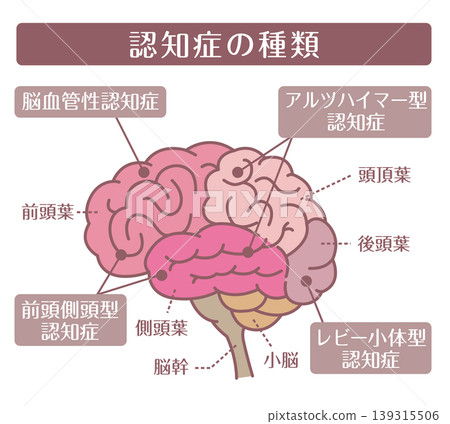 癡呆症的類型:大腦輪廓圖。 癡呆症的類型:大腦輪廓圖。 139315506