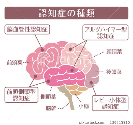 失智症的類型：大腦示意圖（無線條） 139315510
