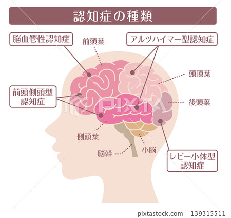 癡呆症的類型：大腦側視圖（無線條） 139315511