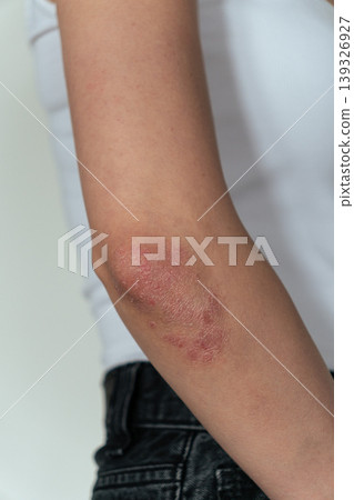 Vertical close-up of woman showing psoriasis on elbow, skin disease and dermatology concept Vertical close-up of woman showing psoriasis on elbow, skin disease and dermatology concept 139326927