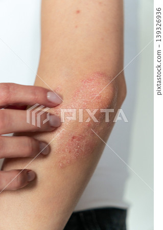 Vertical close-up of woman scratching elbow with psoriasis, skin itching and dermatology concept Vertical close-up of woman scratching elbow with psoriasis, skin itching and dermatology concept 139326936