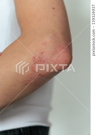 Vertical close-up of woman showing psoriasis on elbow, skin disease and dermatology concept Vertical close-up of woman showing psoriasis on elbow, skin disease and dermatology concept 139326937