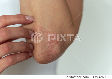 Woman scratching psoriasis on elbow, skin itching and dermatology medical concept 139326939