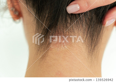 Woman showing psoriasis on neck, dermatology skin condition and healthcare concept Woman showing psoriasis on neck, dermatology skin condition and healthcare concept 139326942