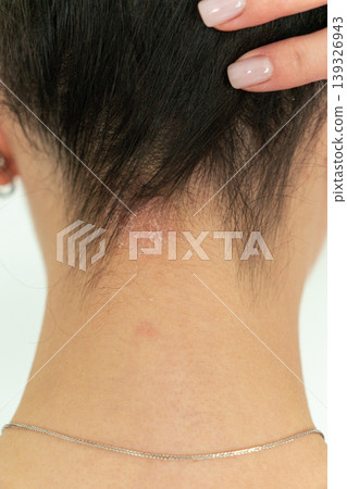 Vertical close-up of woman showing psoriasis on neck, dermatology skin condition concept Vertical close-up of woman showing psoriasis on neck, dermatology skin condition concept 139326943