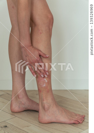 Vertical close-up of woman applying cream on leg with psoriasis, skincare and dermatology treatment concept Vertical close-up of woman applying cream on leg with psoriasis, skincare and dermatology treatment concept 139326969