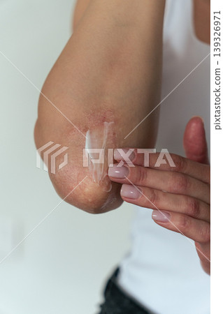Vertical close-up of woman with psoriasis applying cream on elbow, skincare treatment concept Vertical close-up of woman with psoriasis applying cream on elbow, skincare treatment concept 139326971