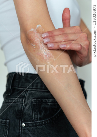 Vertical close-up of woman with psoriasis applying cream on elbow, skincare treatment concept Vertical close-up of woman with psoriasis applying cream on elbow, skincare treatment concept 139326972