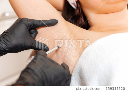 Cosmetologist in black latex gloves makes injection of botulinum toxin on the woman's axillary hollows against hyperhidrosis. Armpit with white drawn grid. Close up Cosmetologist in black latex gloves makes injection of botulinum toxin on the woman's axillary hollows against hyperhidrosis. Armpit with white drawn grid. Close up 139333320
