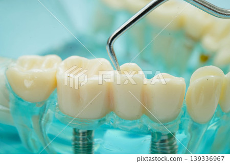 Teeth dental model with tool for dentist use to cleaning care treatment. 139336967