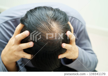 Bald head in man, hair loss treatment health problem. Bald head in man, hair loss treatment health problem. 139341170