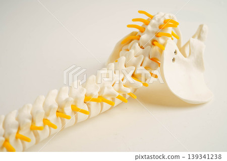 Spinal nerve and bone, Lumbar spine displaced herniated disc fragment, Model for treatment medical in the orthopedic department. 139341238