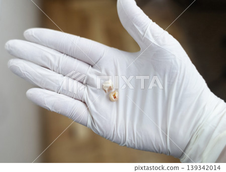 Pediatric dentist in white gloves holding extracted primary milk teeth. Concept of deciduous tooth loss, dental extraction procedure and childhood healthcare. Pediatric dentist in white gloves holding extracted primary milk teeth. Concept of deciduous tooth loss, dental extraction procedure and childhood healthcare. 139342014