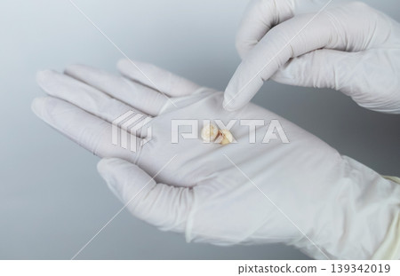 Pediatric dentist in white gloves holding extracted primary milk teeth. Concept of deciduous tooth loss, dental extraction procedure and childhood healthcare. Pediatric dentist in white gloves holding extracted primary milk teeth. Concept of deciduous tooth loss, dental extraction procedure and childhood healthcare. 139342019