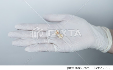 Pediatric dentist in white gloves holding extracted primary milk teeth. Concept of deciduous tooth loss, dental extraction procedure and childhood healthcare. Pediatric dentist in white gloves holding extracted primary milk teeth. Concept of deciduous tooth loss, dental extraction procedure and childhood healthcare. 139342029