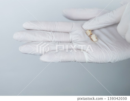 Pediatric dentist in white gloves holding extracted primary milk teeth. Concept of deciduous tooth loss, dental extraction procedure and childhood healthcare. Pediatric dentist in white gloves holding extracted primary milk teeth. Concept of deciduous tooth loss, dental extraction procedure and childhood healthcare. 139342030