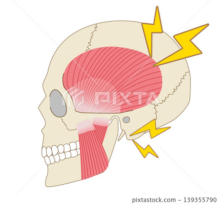 An illustration illustrating the relationship between jaw joint pain and discomfort, teeth grinding, and muscles. 139355790