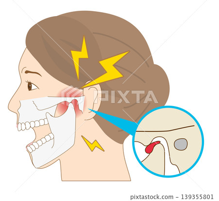 Profile of a woman suffering from jaw pain: Temporomandibular joint disorder anatomical illustration Profile of a woman suffering from jaw pain: Temporomandibular joint disorder anatomical illustration 139355801