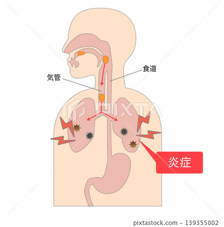 食物進入氣管並引起吸入性肺炎導致肺部發炎的機制。 139355802