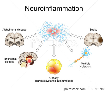 Neuroinflammation. Link between chronic systemic inflammation, stroke, neurodegenerative diseases, Multiple sclerosis, Alzheimers disease, Parkinsons disease, and obesity. ageing process. Neuroinflammation. Link between chronic systemic inflammation, stroke, neurodegenerative diseases, Multiple sclerosis, Alzheimers disease, Parkinsons disease, and obesity. ageing process. 139361986