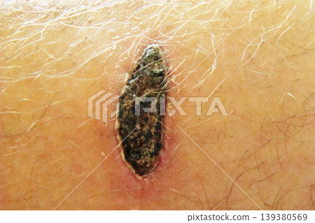 dog bite wound dog bite wound 139380569