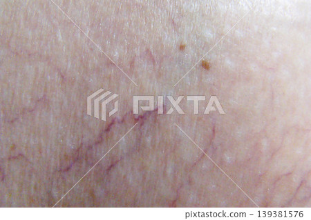 varicose veins varicose veins 139381576