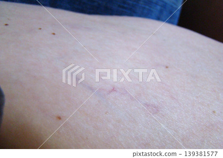 varicose veins varicose veins 139381577