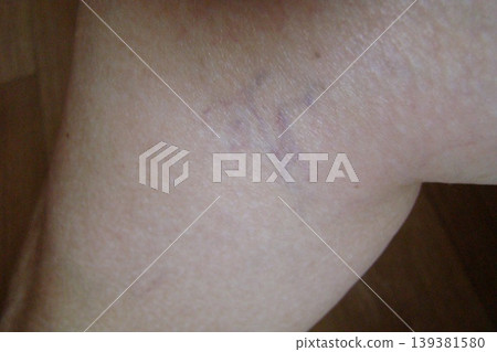 varicose veins varicose veins 139381580