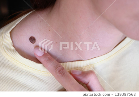 A woman examines a large mole on her neck. A woman examines a large mole on her neck. 139387568
