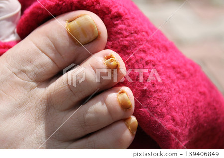 nail fungus 139406849