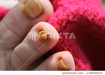 nail fungus 139406850