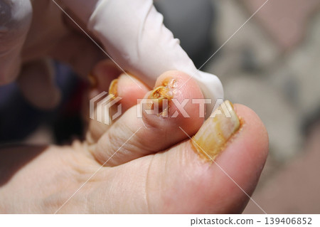 nail fungus 139406852
