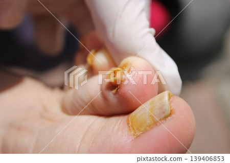 nail fungus 139406853
