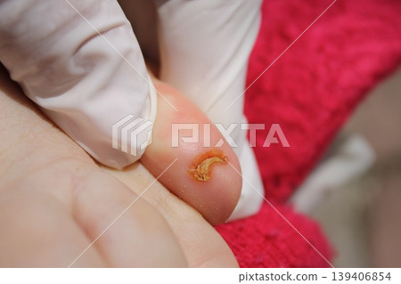 nail fungus 139406854