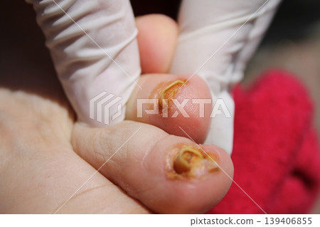 nail fungus 139406855