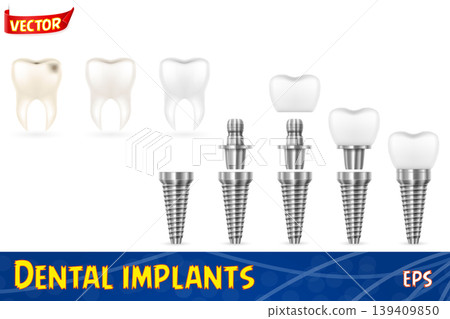 metal human tooth implant vector illustration 139409850