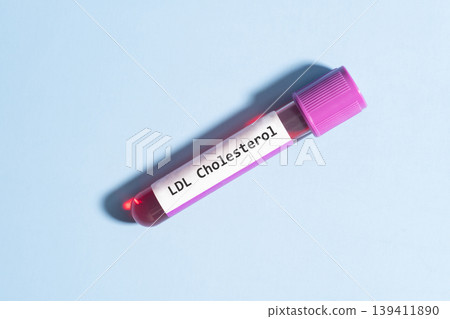 Blood sample tube with LDL cholesterol test label in medical laboratory over blue background. 139411890
