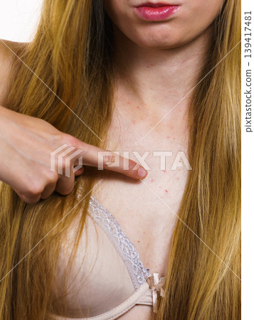 Woman with skin problem acne on neckline Woman with skin problem acne on neckline 139417481