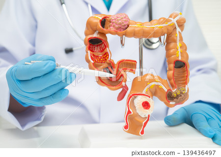 Colorectal cancer, doctor holding intestine colon human model. 139436497