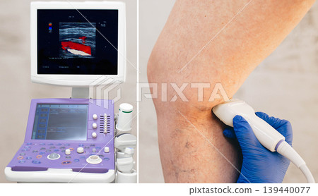 cropped ultrasound exam veins on the leg, vein thrombosis, varicose veins cropped ultrasound exam veins on the leg, vein thrombosis, varicose veins 139440077