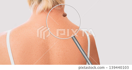 Magnifying glass showing mole on elderly woman skin. Preventive examination of a nevus on the human body Magnifying glass showing mole on elderly woman skin. Preventive examination of a nevus on the human body 139440103