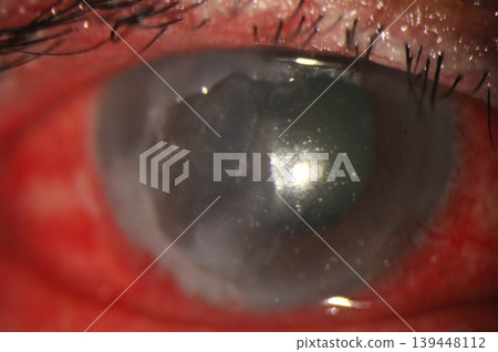 Close-up of a wide corneal epithelial defect observed during eye examination. Close-up of a wide corneal epithelial defect observed during eye examination. 139448112