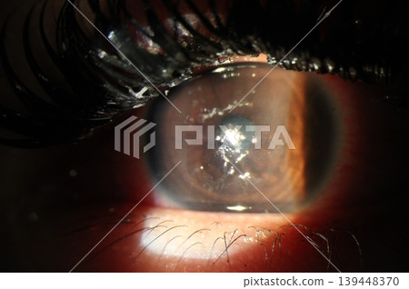 Anterior segment photograph demonstrating a central corneal epithelial defect. Anterior segment photograph demonstrating a central corneal epithelial defect. 139448370